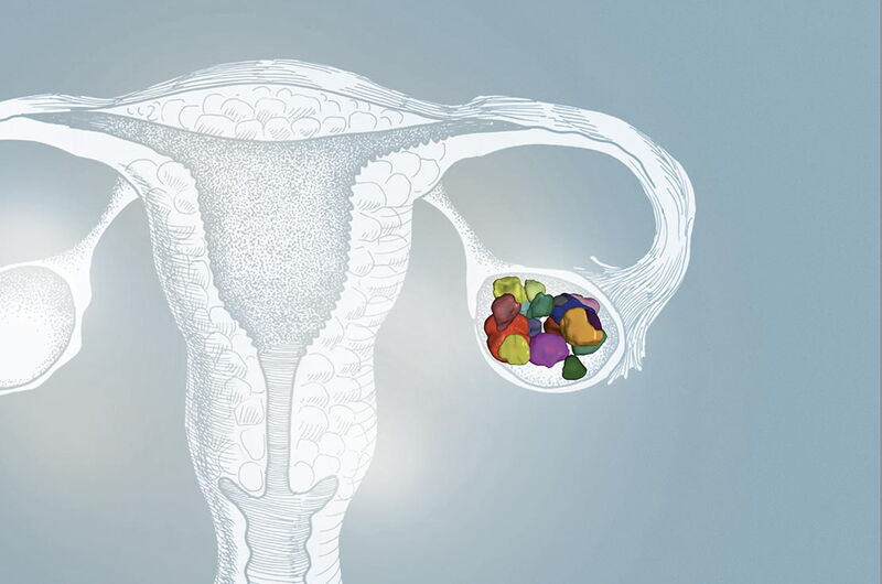 PCO-Syndrom – ein Symptomkomplex